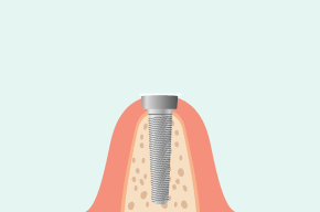 人工的な歯根