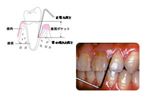 歯周病（歯ぐき）の検査