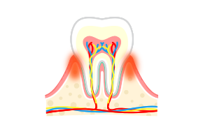 歯肉炎